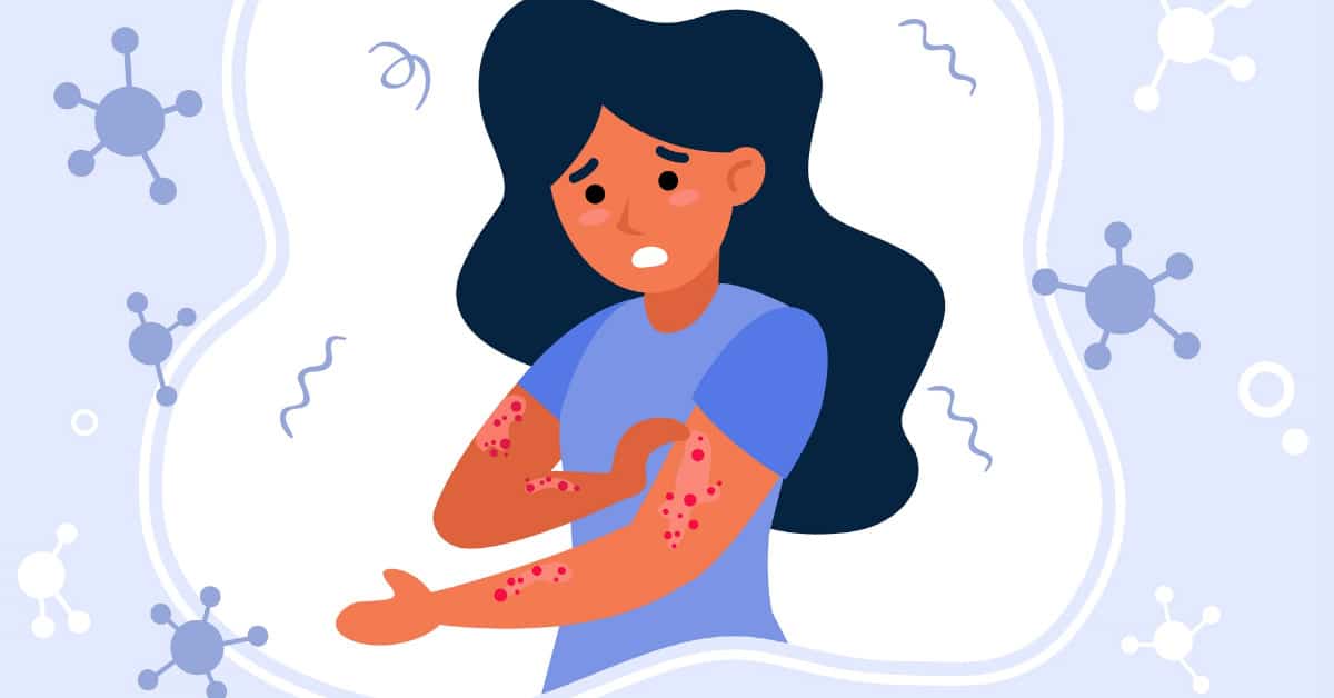 Eczema and Psoriasis